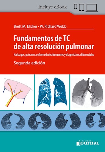 Fundamentos de TC de alta resolución pulmonar